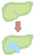 Lebertumor / Leberkarzinom